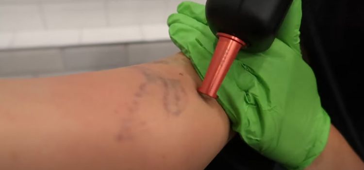 Safe Tattoo Removal Methods