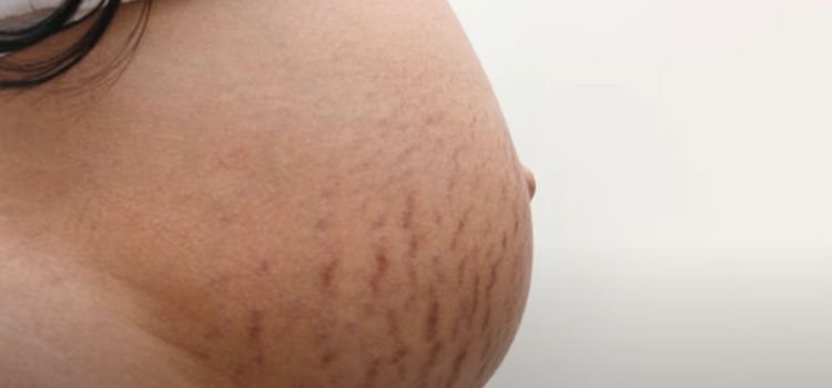 Stretch Marks In The First Trimester