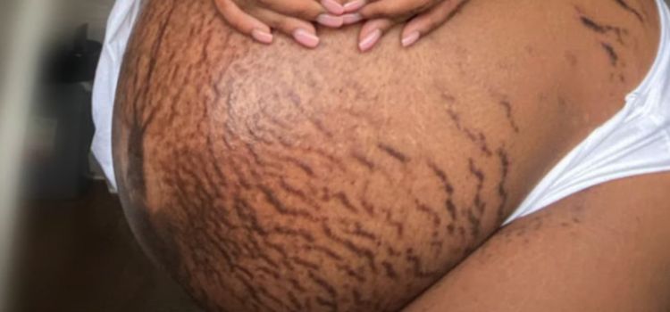 Stretch Marks In The Third Trimester And Beyond
