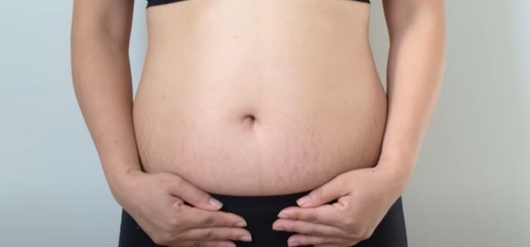 When Do Pregnancy Stretch Marks Appear? Discover the Timelines!