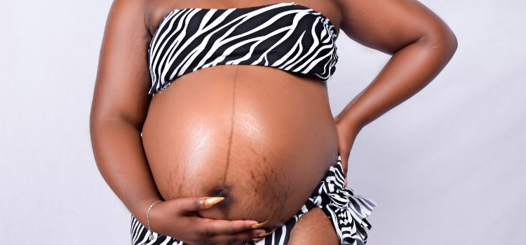 When Do Pregnancy Stretch Marks Appear