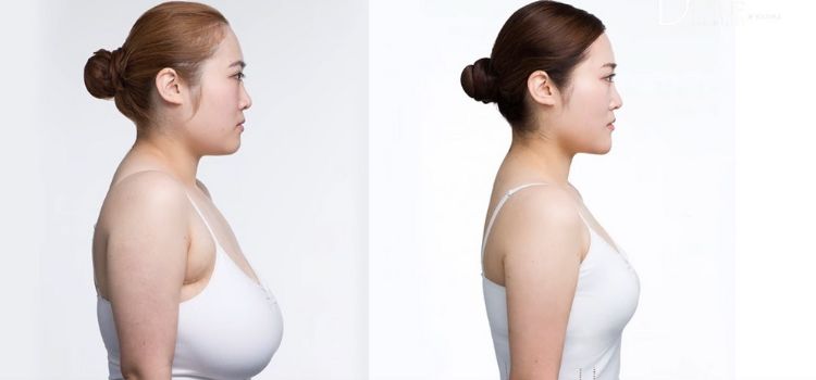 Will Pregnancy Ruin Breast Reduction?  Discover The Truth!